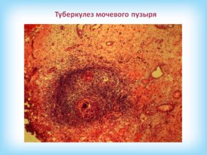Лечение туберкулез мочевого пузыря у женщин. Туберкулез мочеполовой системы – симптомы и лечение. Причины развития болезни