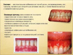 Кровоточивость десен и запах изо рта. Что делать, если кровоточат десна и неприятный запах изо рта даже после чистки зубов: причины и лечение. Почему кровоточат десна