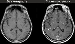 Кто должен вводить контрастное вещество. КТ с контрастным усилением — что покажет исследование? Вредно ли контрастное вещество