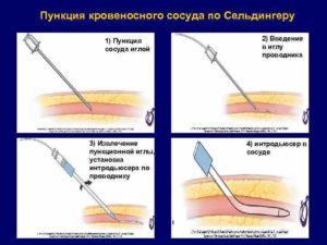 Катетеризация крупных сосудов по сельдингеру. Пункция бедренной артерии по сельдингеру. Пункция магистральных сосудов. Методика Сельдингера