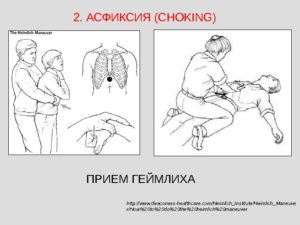 Прием геймлиха пикабу. Прием Геймлиха (Heimlich maneuver)