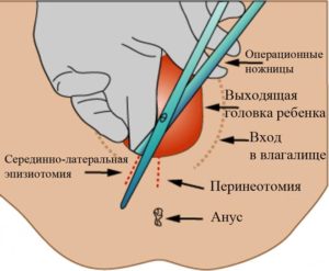 Эпизиотомия как ухаживать за швами. Эпизиотомия при родах: техника, виды, заживление