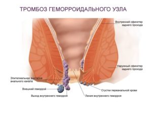 Шарик на сфинктере причины. Симптомы образования возле ануса. Общие сведения о недуге