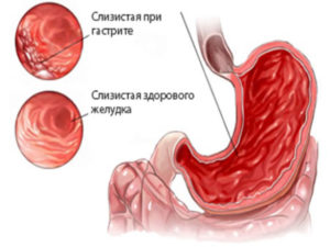 Ли подняться температура от желудка. Температура при гастрите, причины появления и способы борьбы с ней