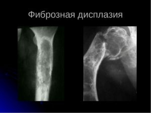 Фиброзно кистозная дисплазия плечевой кости. Фиброзная дисплазия. Фиброзная дисплазия черепа: лечение