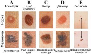 Злокачественные родинки: как распознать и как лечить? Как определить доброкачественная или злокачественная родинка