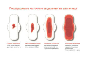 Выделения после лохий. Кровотечения и выделения в послеродовом периоде