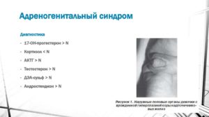 Адреногенитальный синдром у младенца. Адреногенитальный синдром