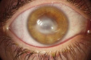 Как лечить воспаление роговицы глаза. Почему развивается кератит и как можно вылечить это заболевание