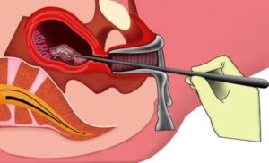 Если не делать чистку матки что будет. Повторная чистка матки: когда она нужна. С какой целью проводят выскабливание