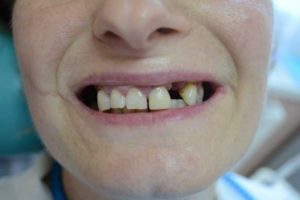 Как восстановить сломанный зуб. Сломал зуб что делать в первую очередь