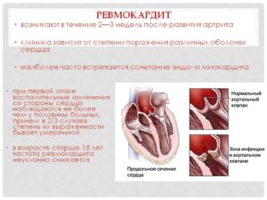 Ревмокардит. Ревмокардит: причины, симптомы, диагностика, лечение, осложнение и прогноз