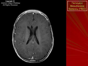 Лейкодистрофия (прогрессирующий склероз мозга). Что за болезнь лейкодистрофия Пелицеуса — Мерцбахера? Лейкодистрофия симптомы
