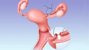 Есть ли случаи беременности с перевязанными трубами. Как забеременеть, если перевязаны трубы