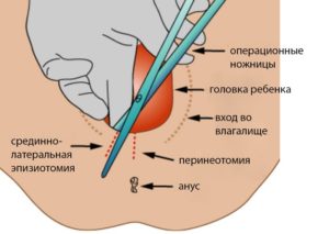 Эпизиотомия как ухаживать за швами. Эпизиотомия при родах: техника, виды, заживление