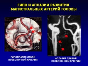 Что означает правая позвоночная артерия малого диаметра. Гипоплазия задних соединительных артерий головного мозга