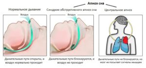 Задержка дыхания во сне: основные симптомы, причины и лечение