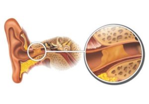 Откуда берется сера в ушах и как бороться с пробками? Почему в ушах образуется сера
