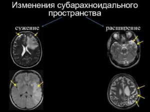 Расширение конвекситальных ликворных пространств. Что представляет собой субарахноидальное пространство