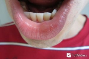 Появилась шишка на верхней губе. Почему вылезла шишка на губе – природа симптоматики и методы терапии. Рак губы симптомы, рак нижней и верхней губы