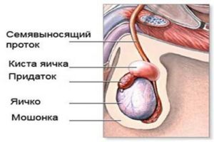 Причины и лечение уплотнений на коже мошонки. Шишка (нарост) на яичке у мужчины