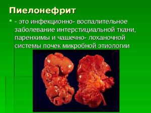 Пиелонефрит почек от чего бывает. Реабилитация после болезни. Причины возникновения пиелонефрита