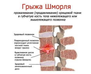 Восстановление хрящевой ткани позвоночника. Как восстановить межпозвоночные диски. Яичная скорлупа при патологиях суставов