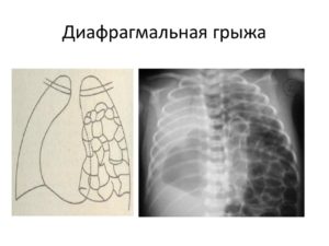 Чем опасна диафрагмальная грыжа у новорожденных. Диафрагмальная грыжа у новорожденных