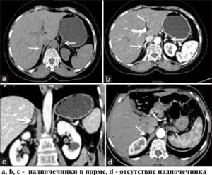 Как делают кт надпочечников с контрастом. Кт надпочечников с контрастированием. Показания и специфика