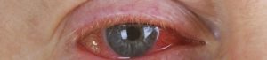 Лечение кандидозного конъюнктивита. Грибковый конъюнктивит глаз лечение у взрослых. Мази для глаз