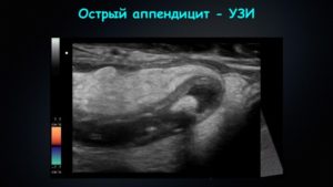 Можно ли диагностировать аппендицит по узи. Что показывает исследование? Атипичные положения аппендикса