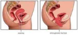 Опущение матки: симптомы, стадии, лечение, профилактика. Почему яичник припаян или находится за маткой