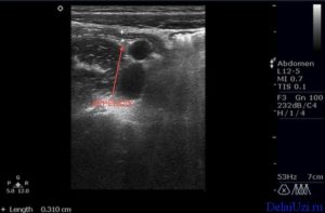 Можно ли диагностировать аппендицит по узи. Что показывает исследование? Атипичные положения аппендикса