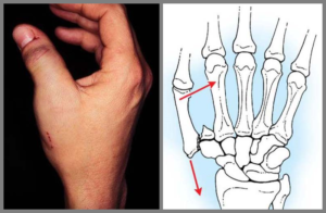 Сколько срастается трещина в кости на пальце. Причины трещин в костях, как определить и как лечить