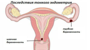 Мало эндометрия в матке. Почему появляется тонкий эндометрий