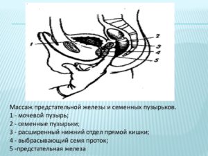 Как сделать массаж предстательной железы дома. Массаж простаты дома — за и против