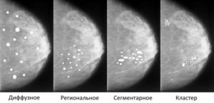 Кальцинаты в молочной железе. Это признак рака или нет. Кальцинаты у женщины в грудной железе - причины и лечение Единичные кальцинаты в молочной железе на маммографии