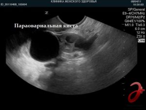 Жидкостное образование правого яичника. Кистозное образование правого яичника