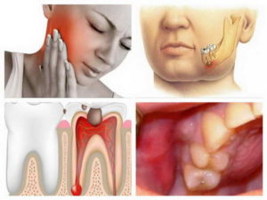 Что делать, когда болят зубы при простуде. Почему при простуде, во время гриппа и орви болят зубы и воспаляются десны, как лечить полость рта