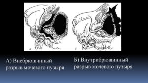 Разрыв мочевого пузыря: симптомы, лечение. Когда может лопнуть мочевой пузырь и какие последствия