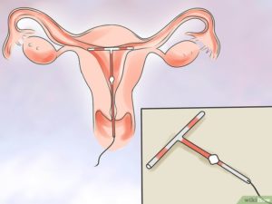 Беременность после спирали совет гинеколога. Можно ли забеременеть после удаления спирали, советы гинеколога