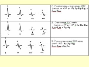 Синусовый ритм отклонение эос вправо у ребенка. Что такое электрическая ось сердца и какие могут быть последствия отклонений от нормы? Измерение показателей электрокардиографией