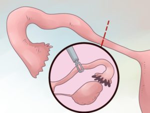 Месячные после операции по удалению маточных труб. Причины и характер выделений после удаления матки