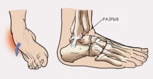 Как отличить растяжение от разрыва мышц. Как определить повреждение голеностопного сустава — вывих или растяжение
