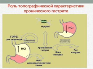 Симптомы, причины и лечение нулевой кислотности желудка. Лечение при нулевой кислотности желудка