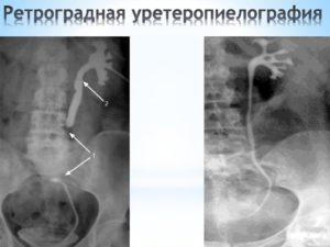 Ретроградная пиелография как проводится. Ретроградная уретеропиелография. Что можно, а что нельзя есть в процессе подготовки