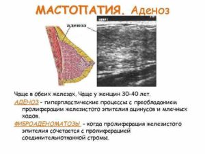 Фам правой молочной железы лечение. Лок фам молочной железы что это такое. Симптомы и формы фиброаденоматоза