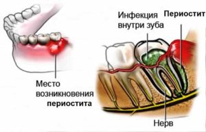 Воспаление надкостницы зуба лечение народными средствами. Чем опасно воспаление надкостницы зуба и методы его лечения
