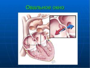 Овальное окно 9 лет может ли закрыться. Если у ребенка обнаружили открытое овальное окно в сердце