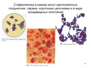 Лечение стафилококковой стрептококковой инфекции матки. Золотистый стафилококк у женщин в мазке